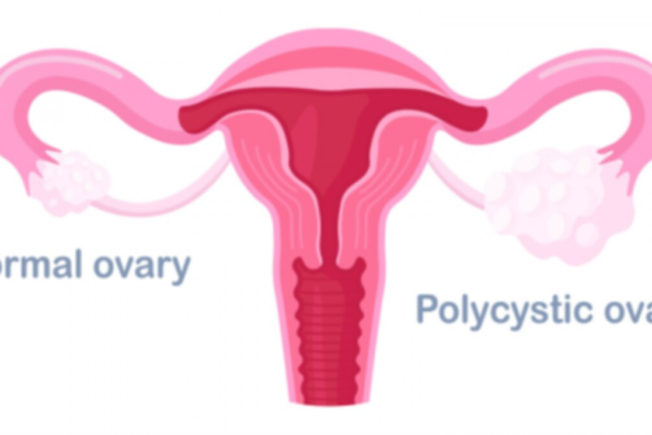 The Connection Between PCOS and Thyroid Disorders – News18