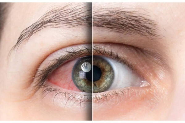 Diabetes Symptoms: 5 ways Diabetes impacts the eyes