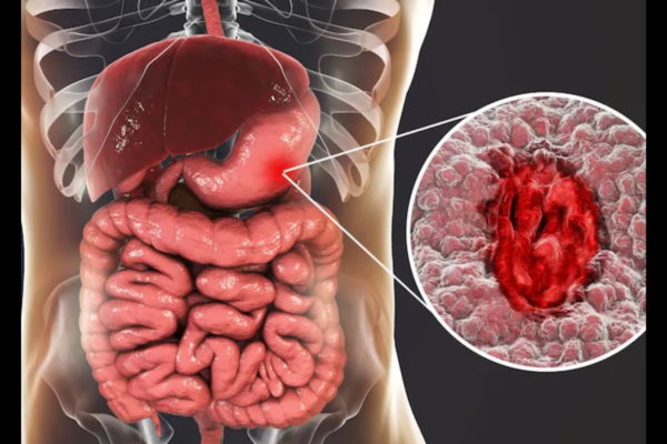Your Gut Could Be In Danger: How Common Painkillers Are Silently Damaging Your Intestines News18