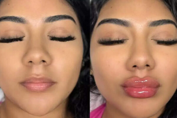 Are lip fillers safe and effective? Know the risks and what to consider before you try | – Times of India