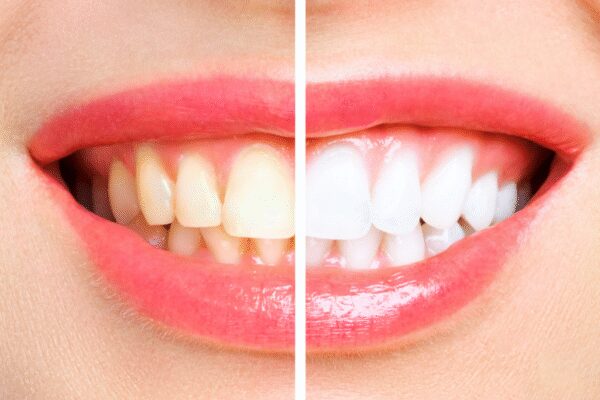 How to remove yellow stains from teeth: 3 tips that always work – Times of India