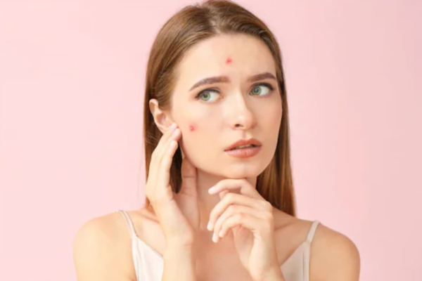Pimples Getting Worse During The Rainy Season? Here’s How To Keep Your Skin Clear News18