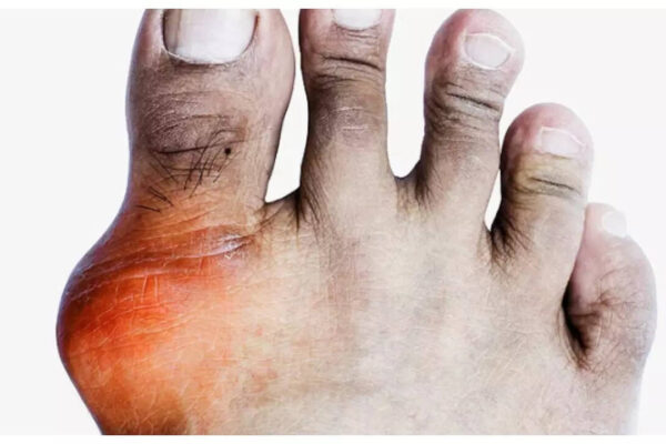How to safely lower Uric Acid in 3 months
