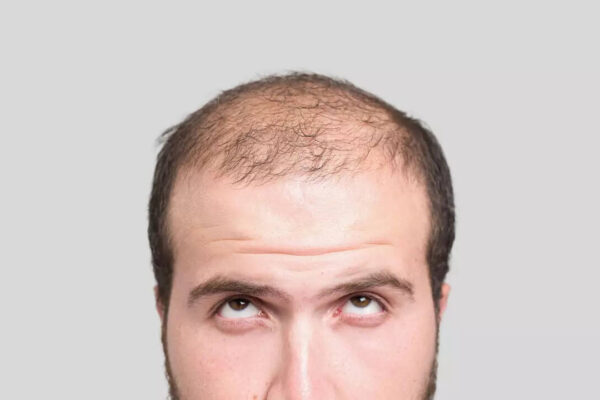 Is there a link between baldness and heart health?