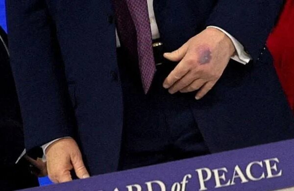 Trump's hands seen bruised in new photos