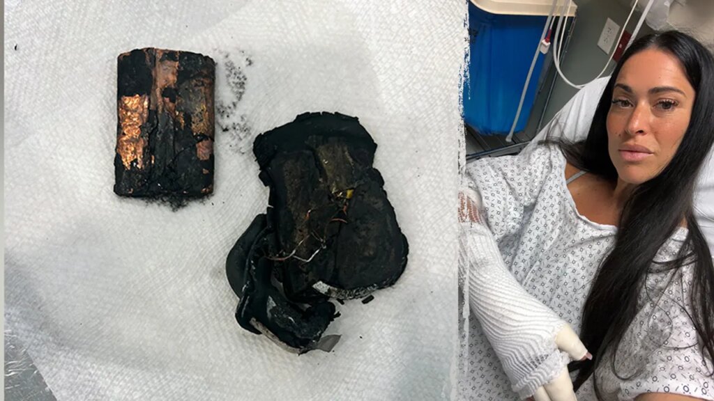 California woman hospitalized with chemical burns after portable charger explodes