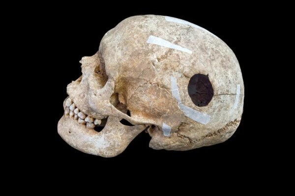 Archaeologists uncover evidence of early brain surgery on 9th-century man