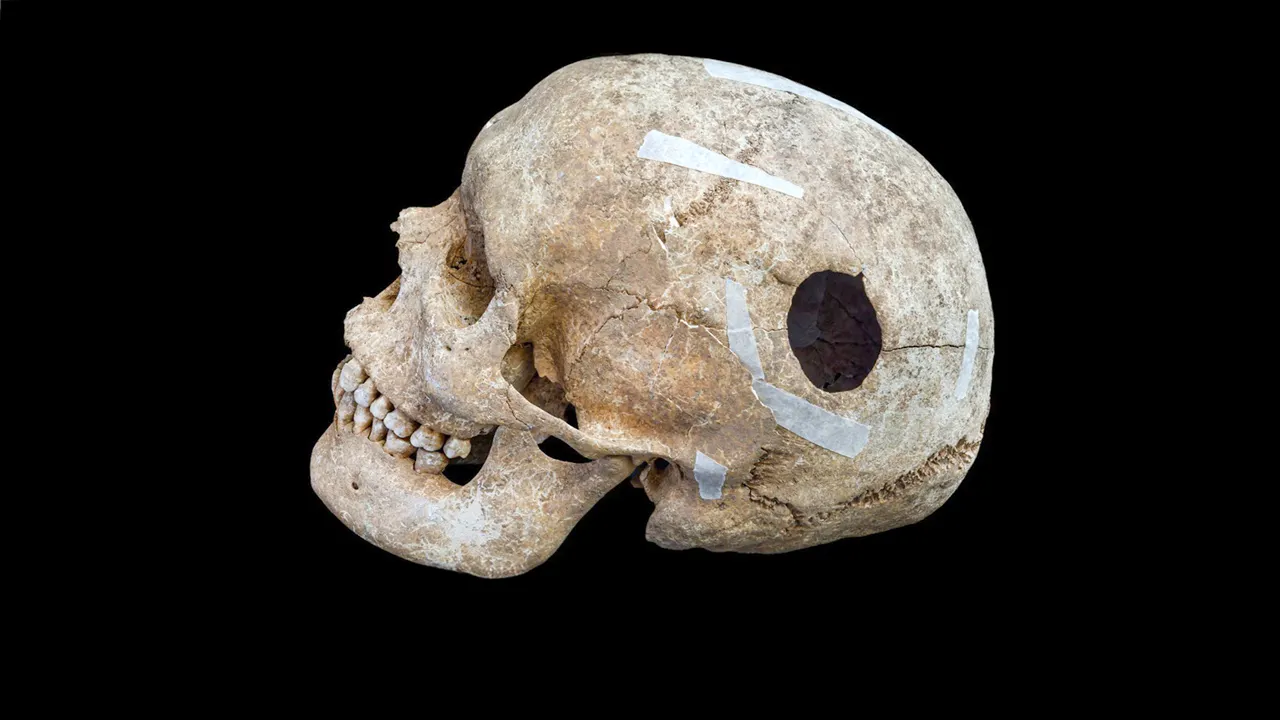 Archaeologists uncover evidence of early brain surgery on 9th-century man