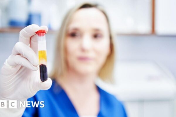 Blood test for 50 cancers fails key goal in NHS trial