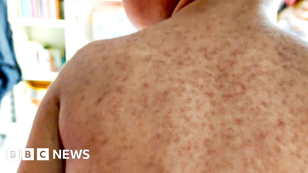 North London measles outbreak: Unvaccinated pupils could be excluded from school