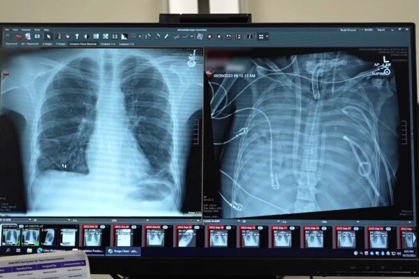 Surgeons keep man alive without lungs, paving new path to transplant