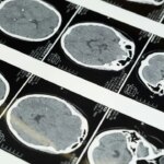 China’s ultrasound brain tech race heats up