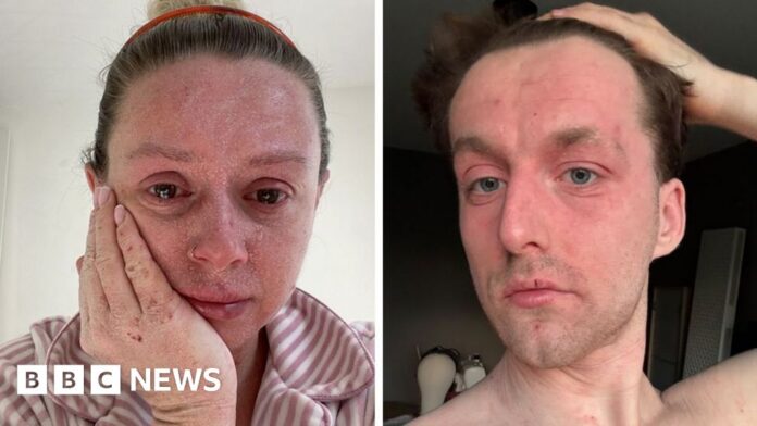 Life with TSW: 'Our skin is falling off and no-one can tell us why '