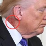 Trump's neck rash sparks fresh health questions