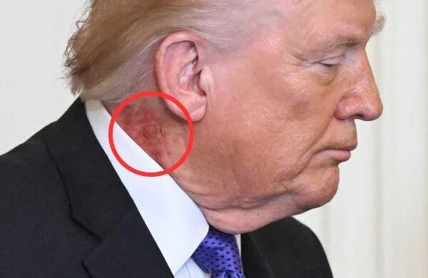 Trump's neck rash sparks fresh health questions