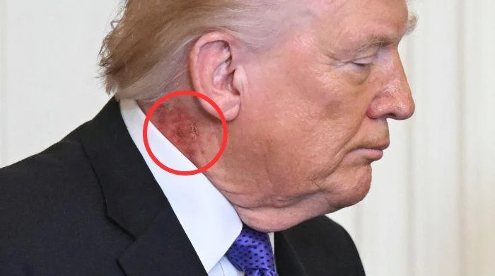 Trump's neck rash sparks fresh health questions
