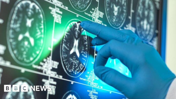 'Breakthrough' Alzheimer's drugs unlikely to benefit patients, report suggests