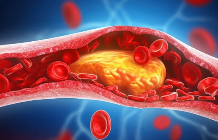High cholesterol: the ‘silent killer’ that raises heart disease and stroke risks - SUCH TV