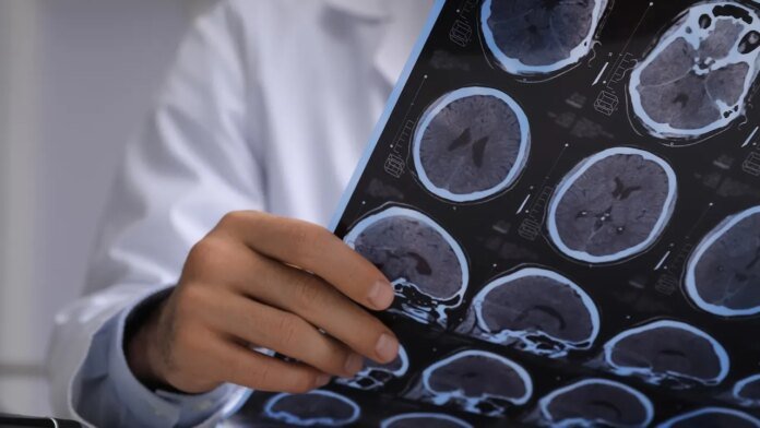 Doctors thought man had brain cancer — they found live tapeworms instead