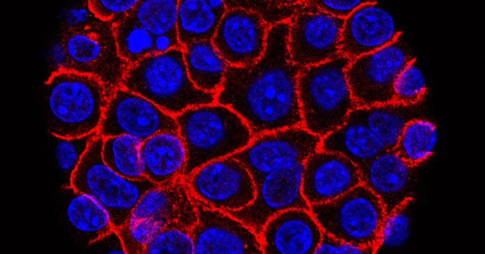 New drug nearly doubles survival rates in some pancreatic cancer patients, study says