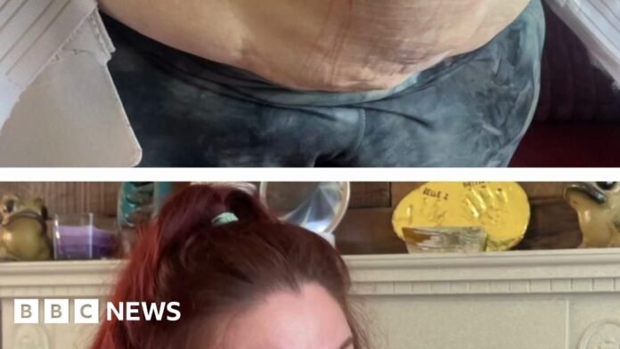 'Why I'm showing my hernia online'