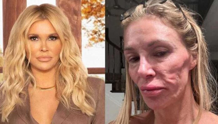 Brandi Glanville calls out doctors amid ongoing facial disfigurement struggle