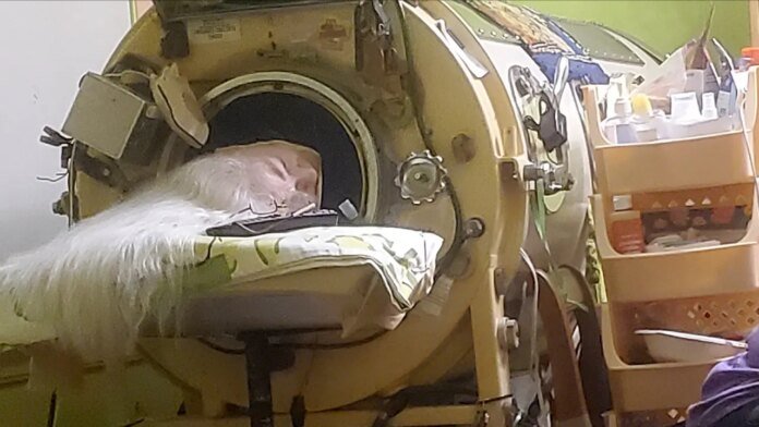 Last American to use an iron lung dies at 78 years old after childhood polio diagnosis