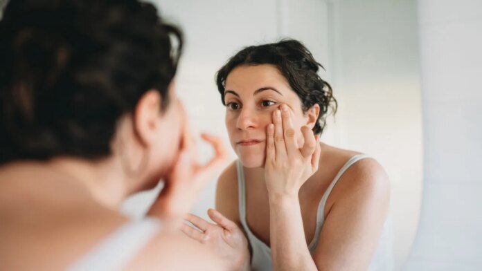 Skin condition under the eyes goes viral as doctors warn it could signal hidden health issue